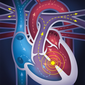 Heart disease Heart disease