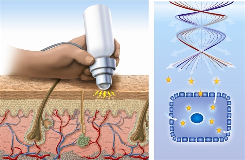 Electroporation 1